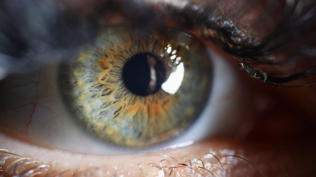 laser eye surgery
